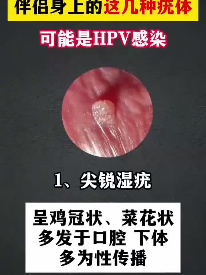 伴侣皮肤长出疣体,需警惕HPV病毒感染风险