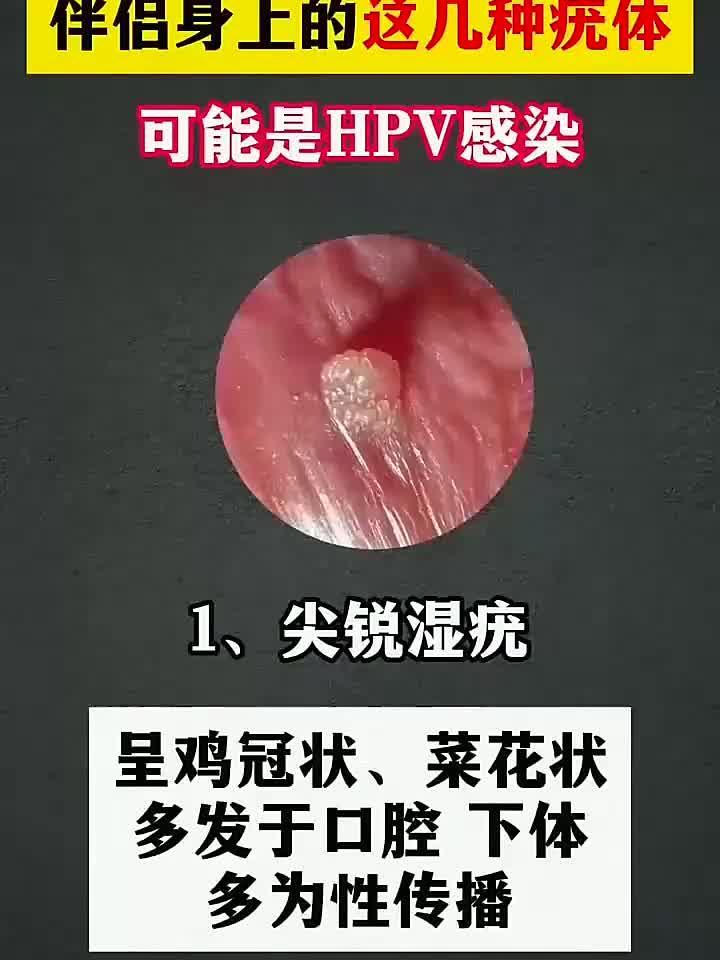 伴侣身上长疣?警惕HPV感染的信号!
