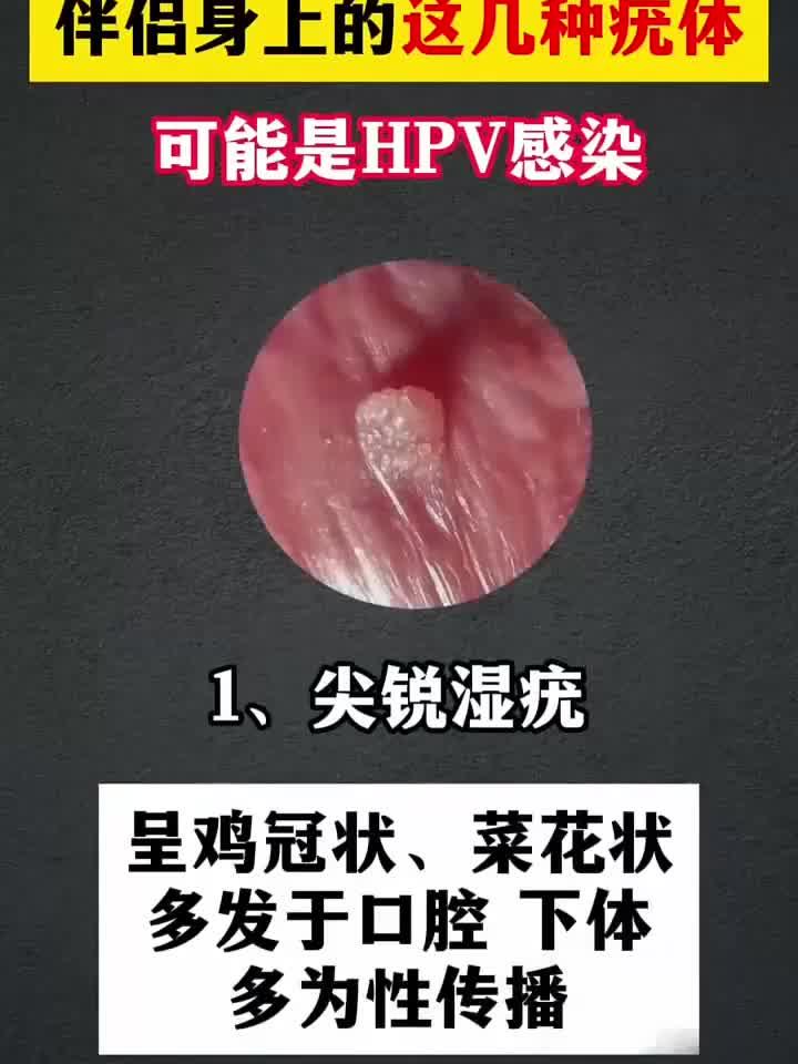 伴侣身上的这几种疣体 可能是hpv感染