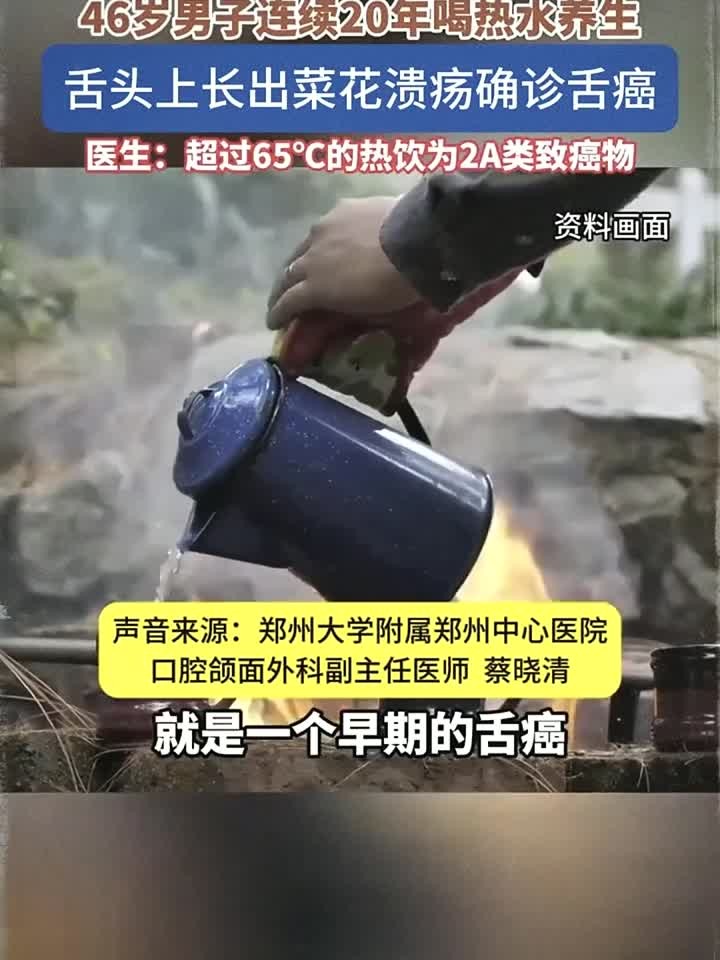 岁男子坚持喝热水年养生竟患舌癌舌头长出菜花状溃疡