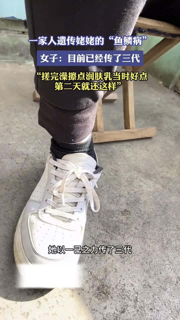一家人遗传姥姥的“鱼鳞病”，女子：目前已经传了三代，搓完澡擦点润肤乳当时好点第二