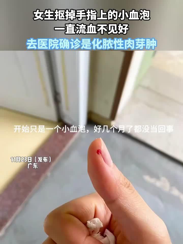 女生抠掉手指上的小血泡，一直流血不见好，确诊是化脓性肉芽肿