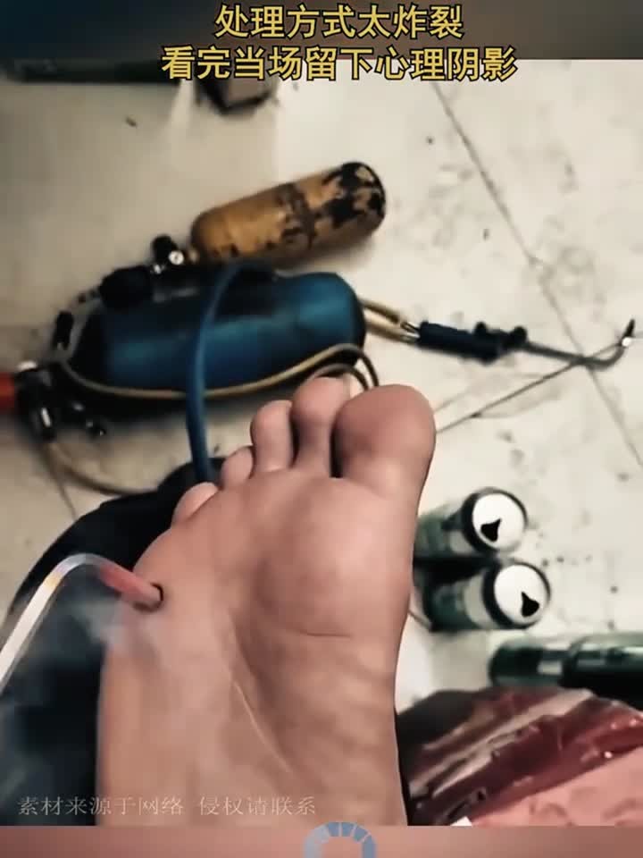 男子脚上长鸡眼，处理方式太炸裂，看完当场留下心理阴影！