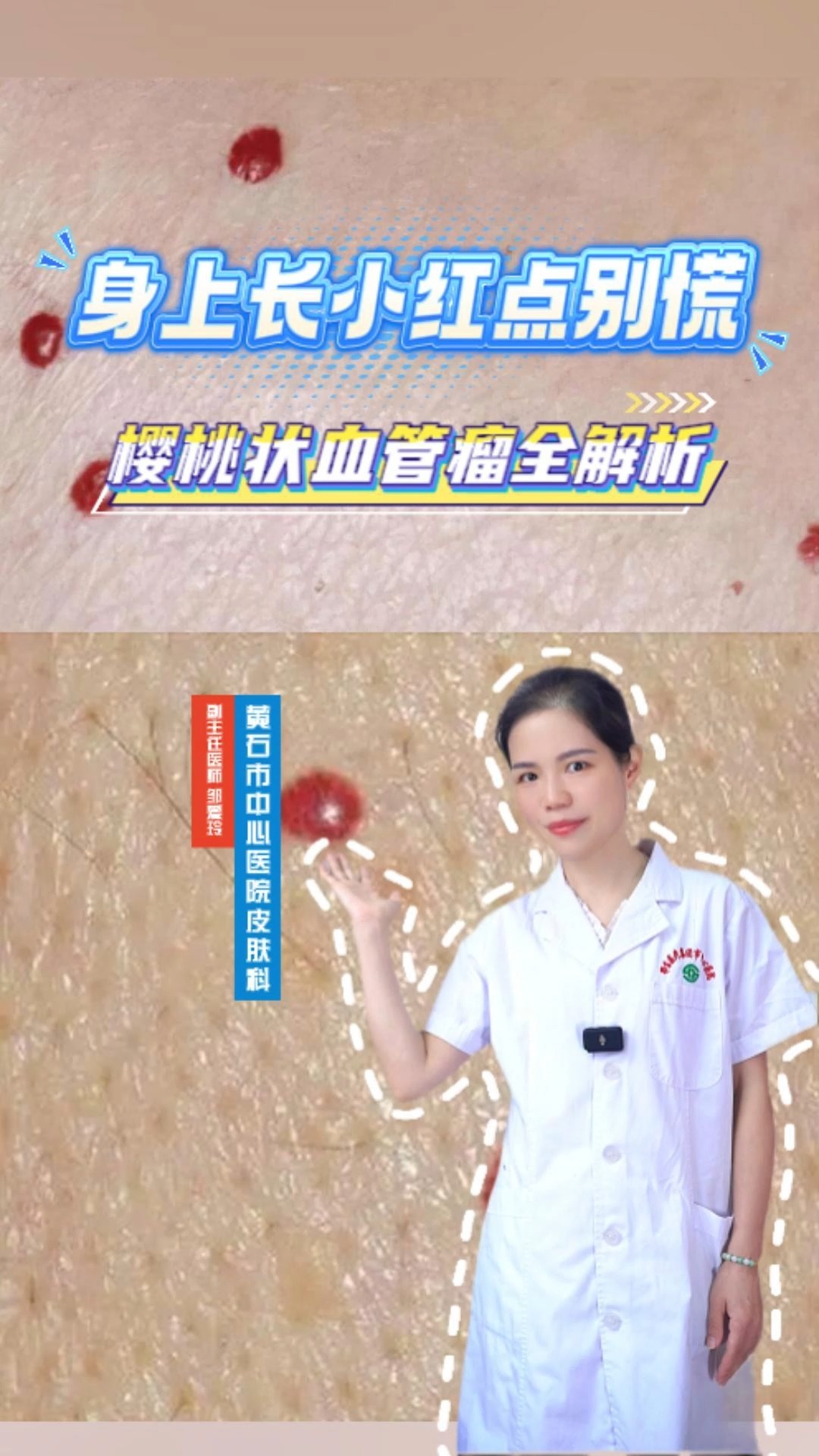 身上长小红点别慌!樱桃状血管瘤全解析