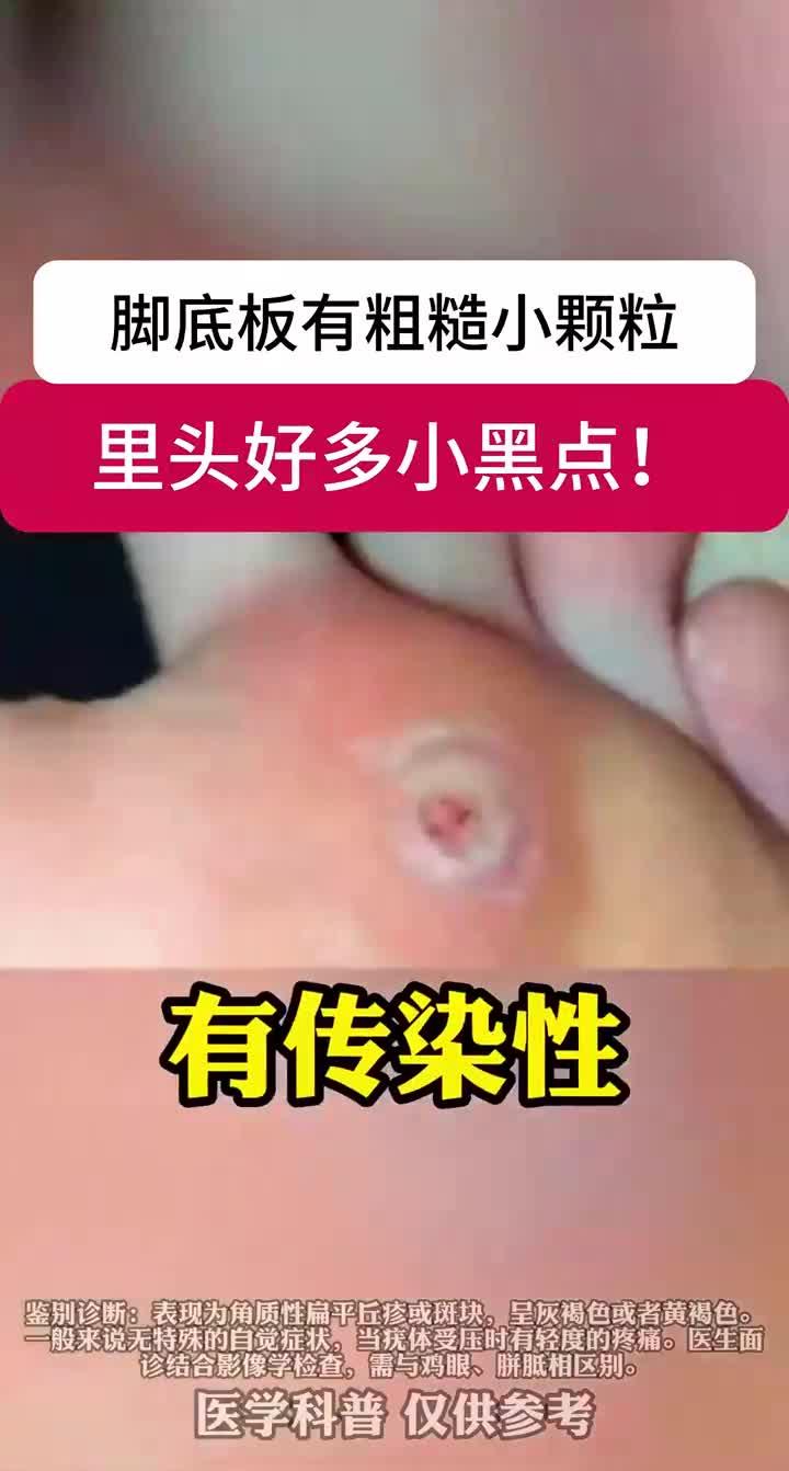 脚底板长小疙瘩,里面有很多小黑点,可别当鸡眼治!这是跖疣