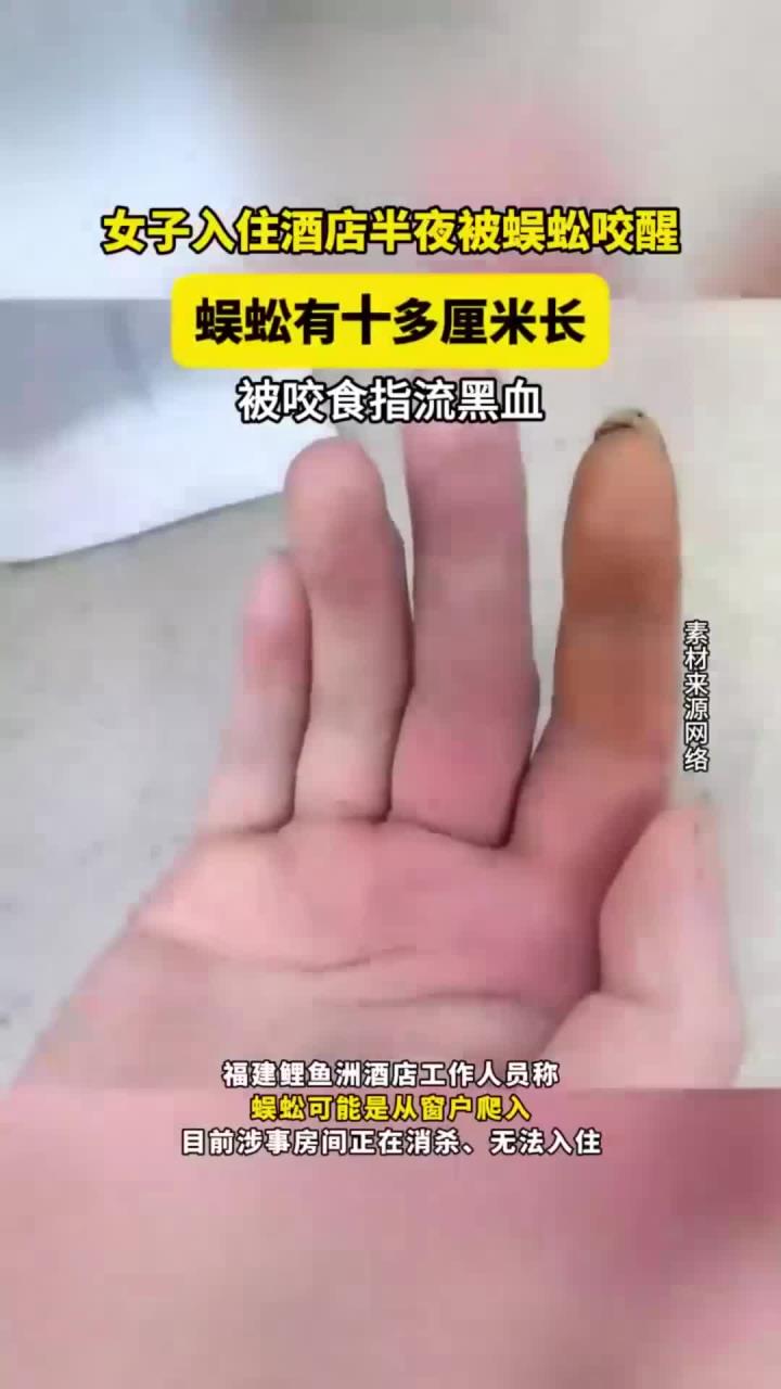 女子入住酒店半夜被蜈蚣咬醒