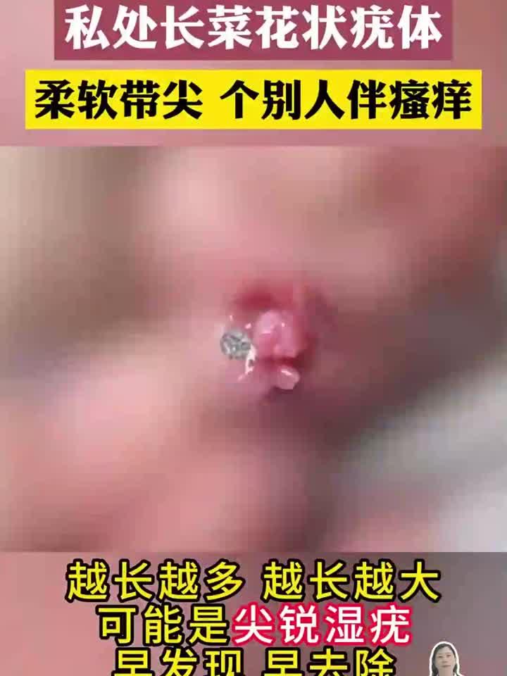 私处长菜花状疣体