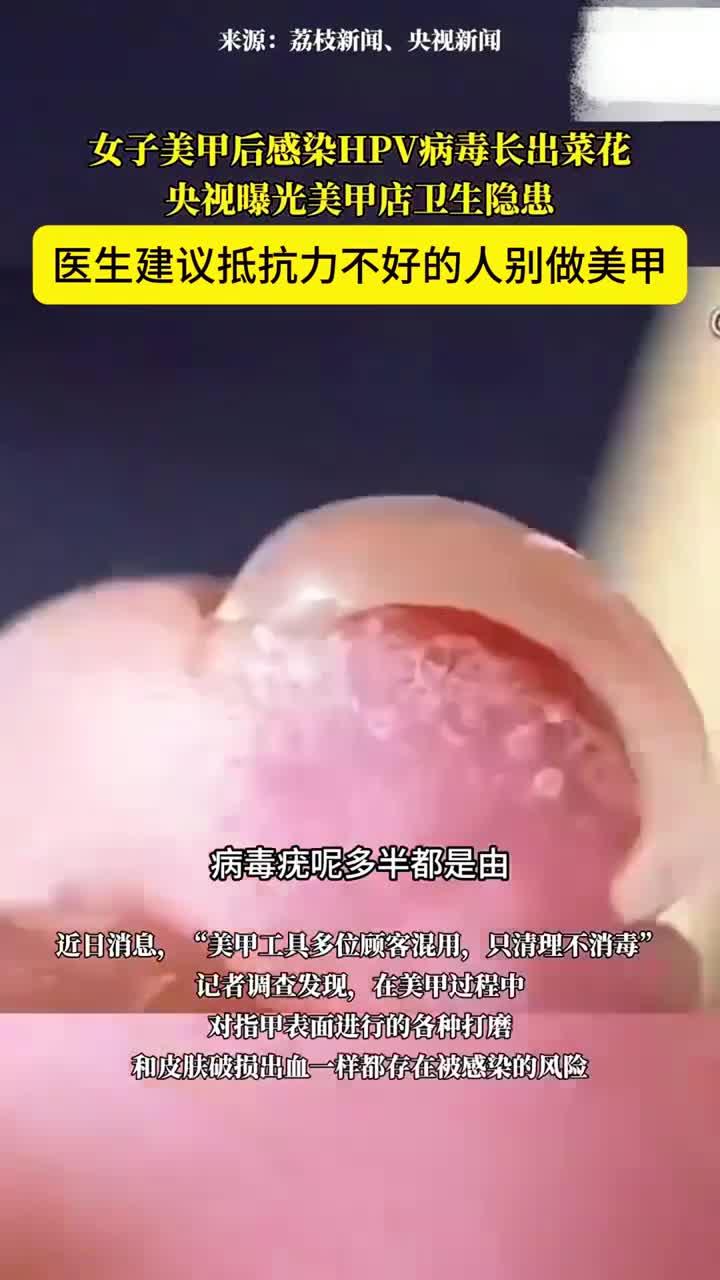 美甲后感染HPV长菜花状疣