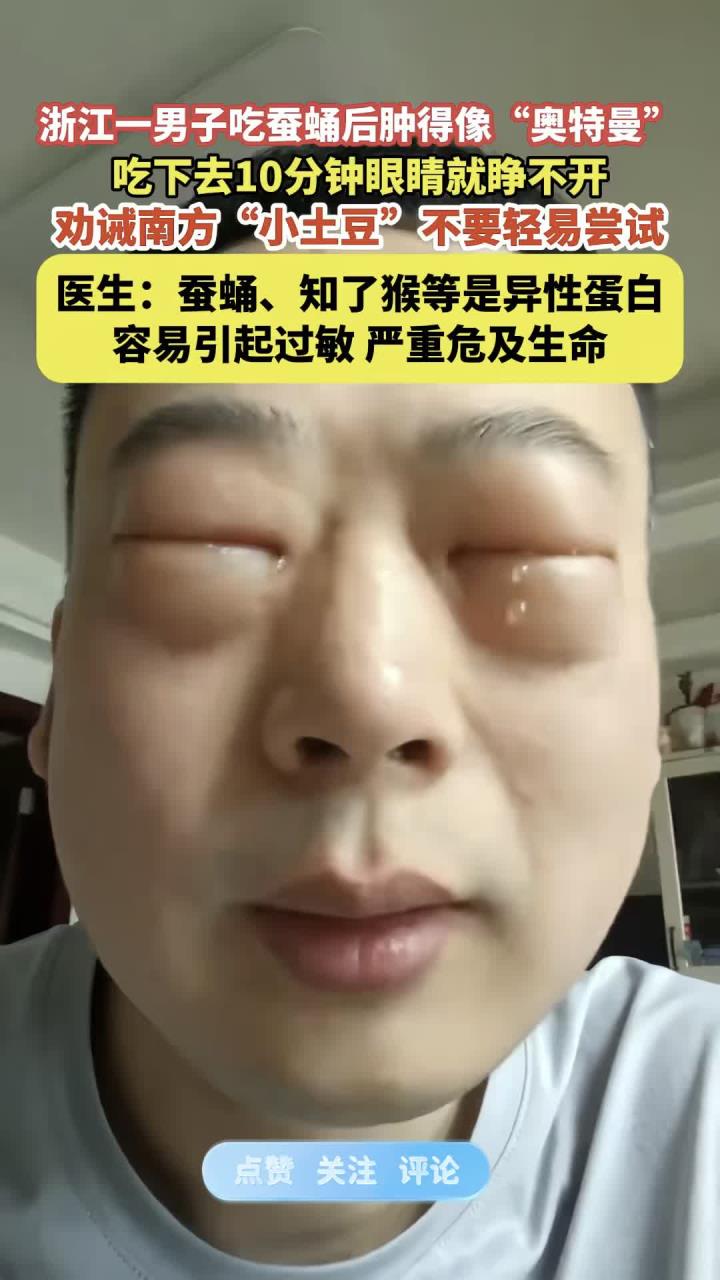 健康箴言:一男子吃 后肿得像“奥特曼”