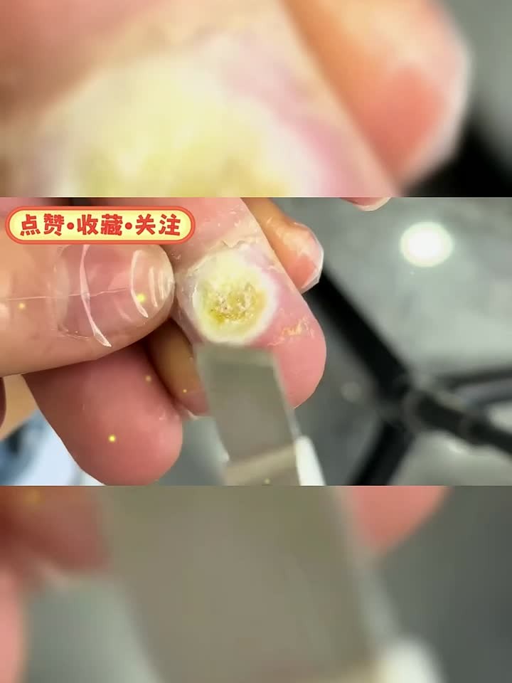 打麻将感染,手上罕见跖疣!
