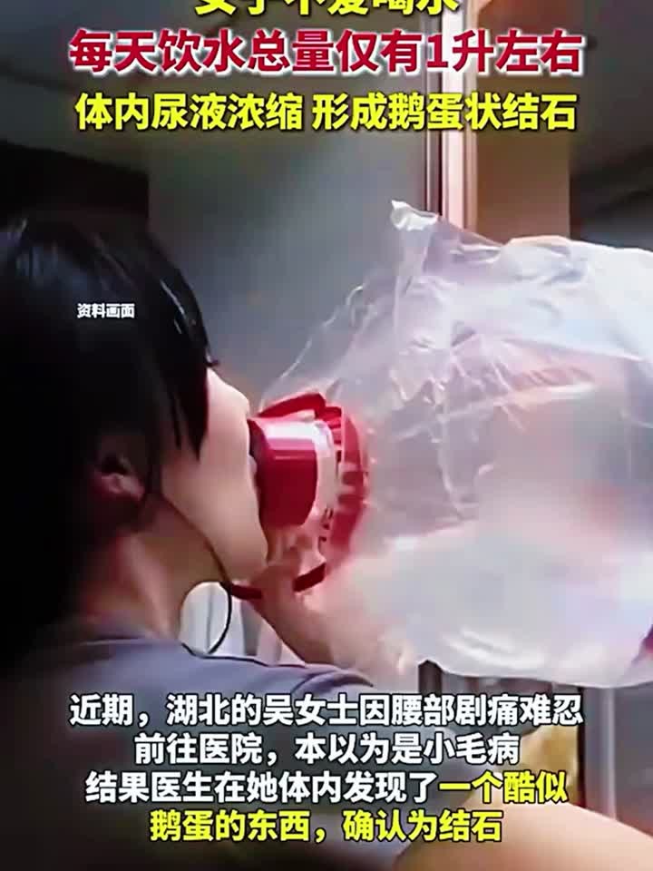 女子不爱喝水,每天饮水总量仅有1升左右,体内尿液浓缩,形成鹅
