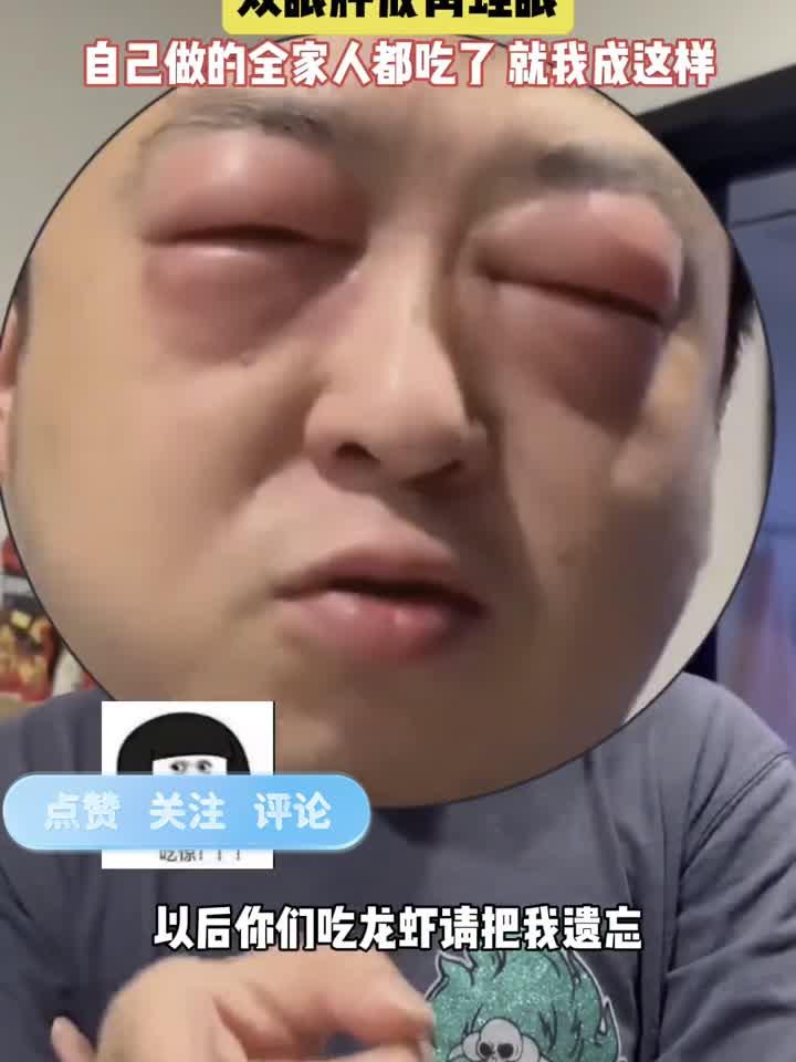 男子吃小龙虾后双眼严重过敏,肿成“青蛙眼”