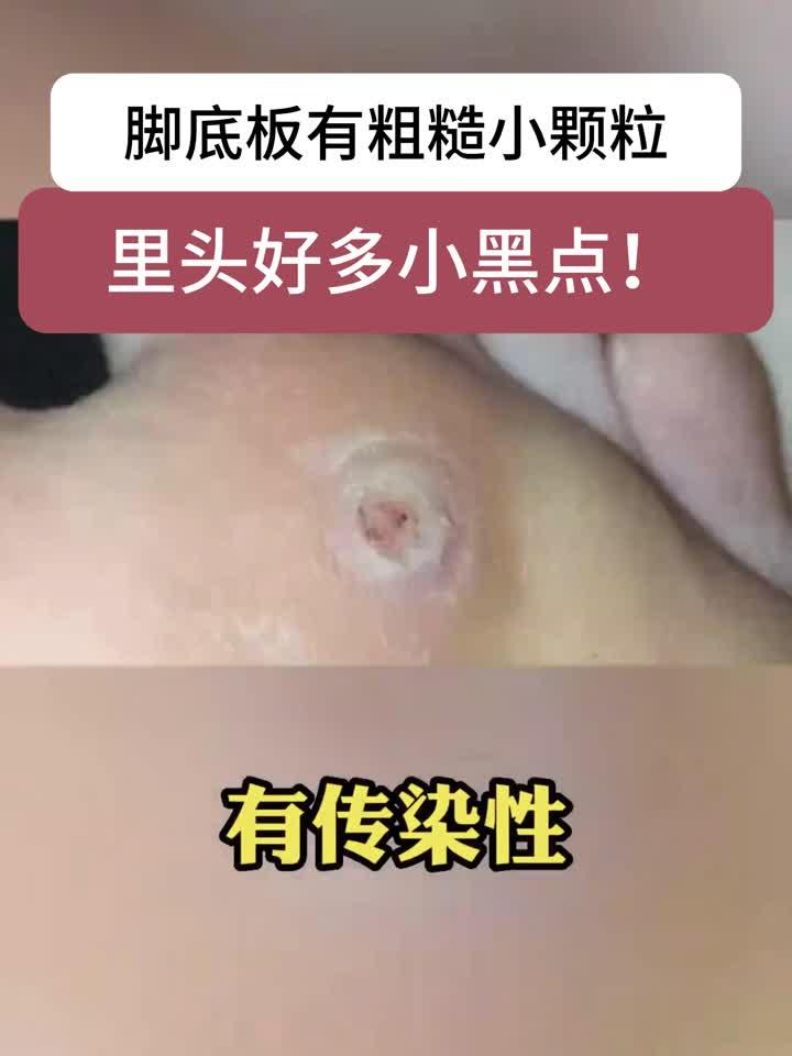 脚底板长小疙瘩,里面有很多小黑点,可别当鸡眼治!这是跖疣