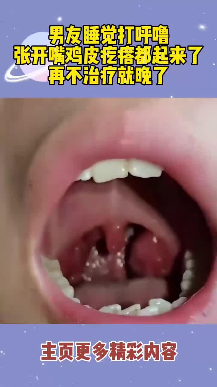 男友睡觉打呼噜,张开嘴鸡皮疙瘩都起来了,再不治疗就晚了