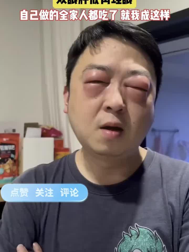 男子吃小龙虾后突发严重过敏，双眼红肿如蛙眼警示食品安全