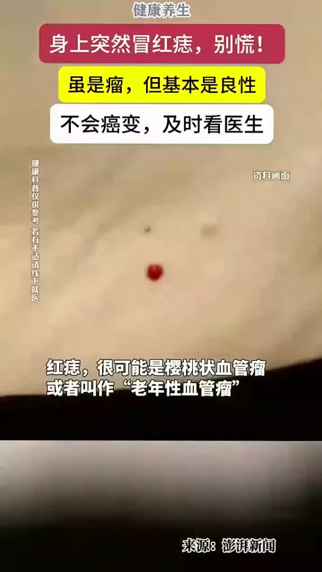 身上长出红色小肉痣不用恐慌，大多良性一般不会恶变