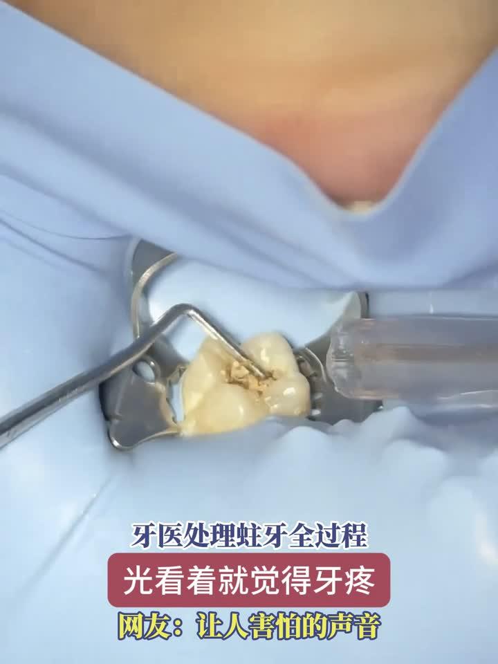 牙医如何一步步消灭蛀牙?全程实拍治疗细节,看完感同身受!