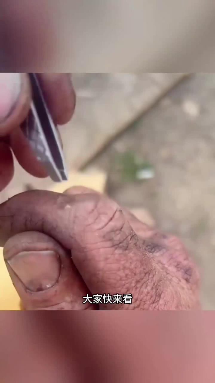 粗糙的双手,长了一个肉刺