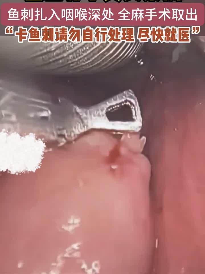 惊险！鱼刺深喉，医生全麻手术取出真实案例