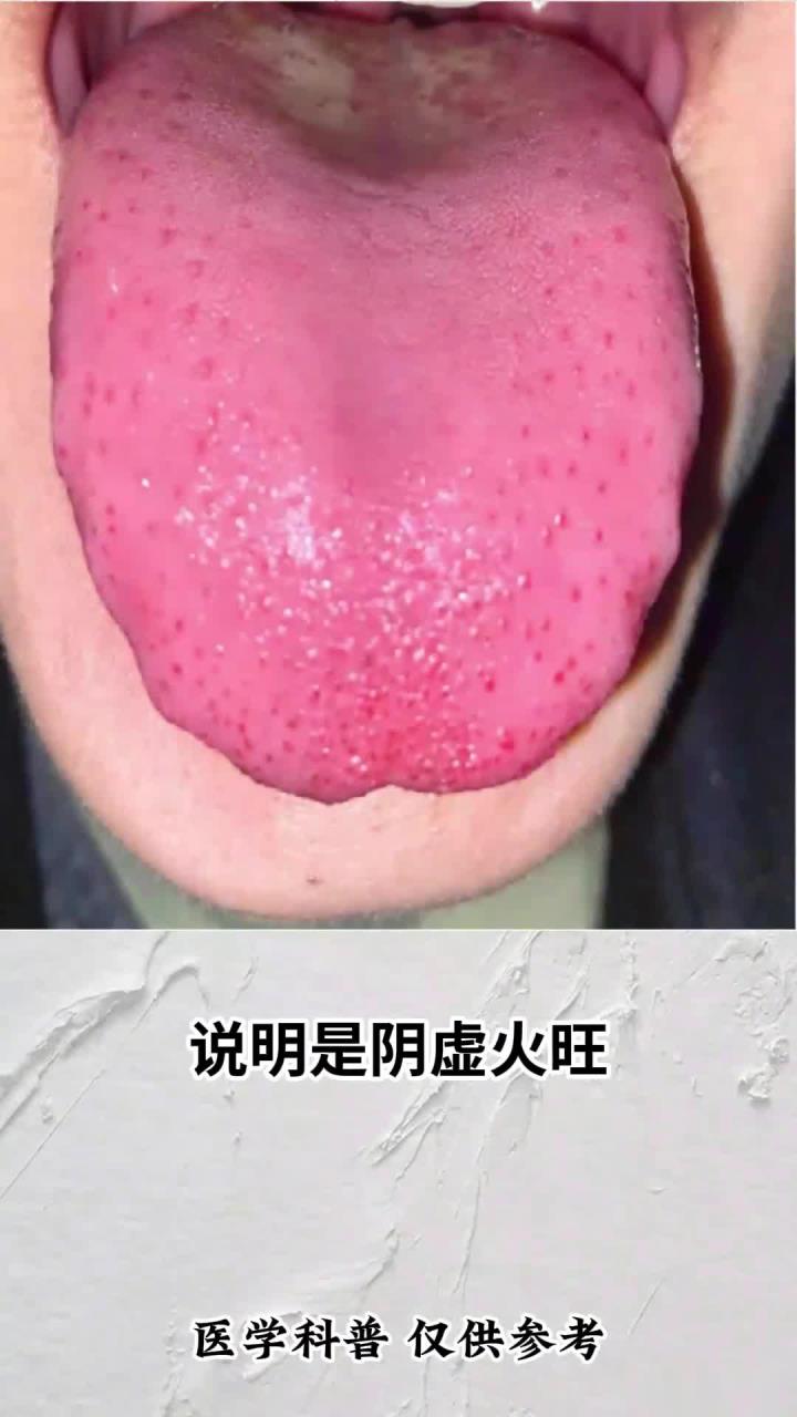 阴虚火旺,内容,注意!