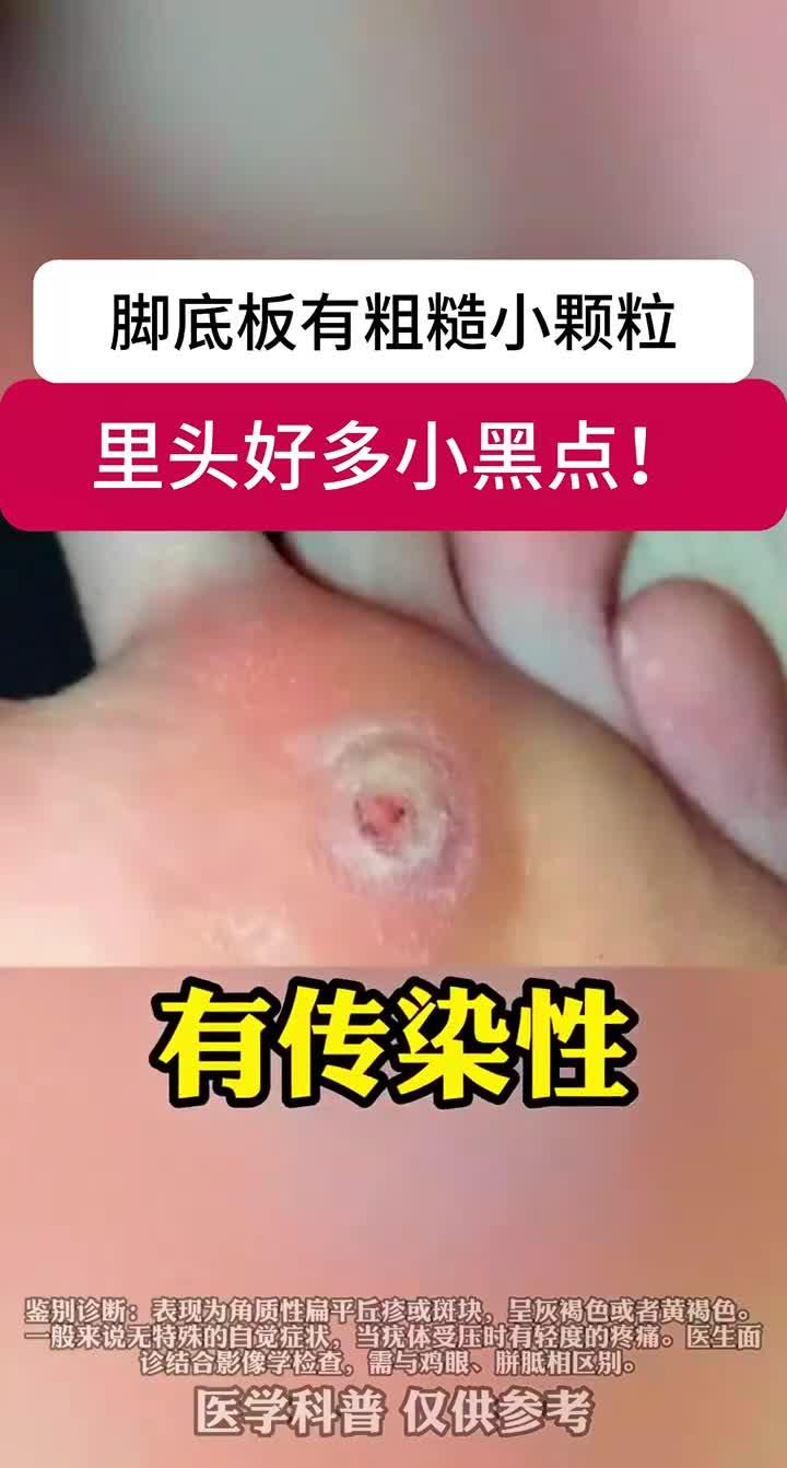 脚底板长小疙瘩,里面有很多小黑点,可别当鸡眼治!这是跖疣 (1)