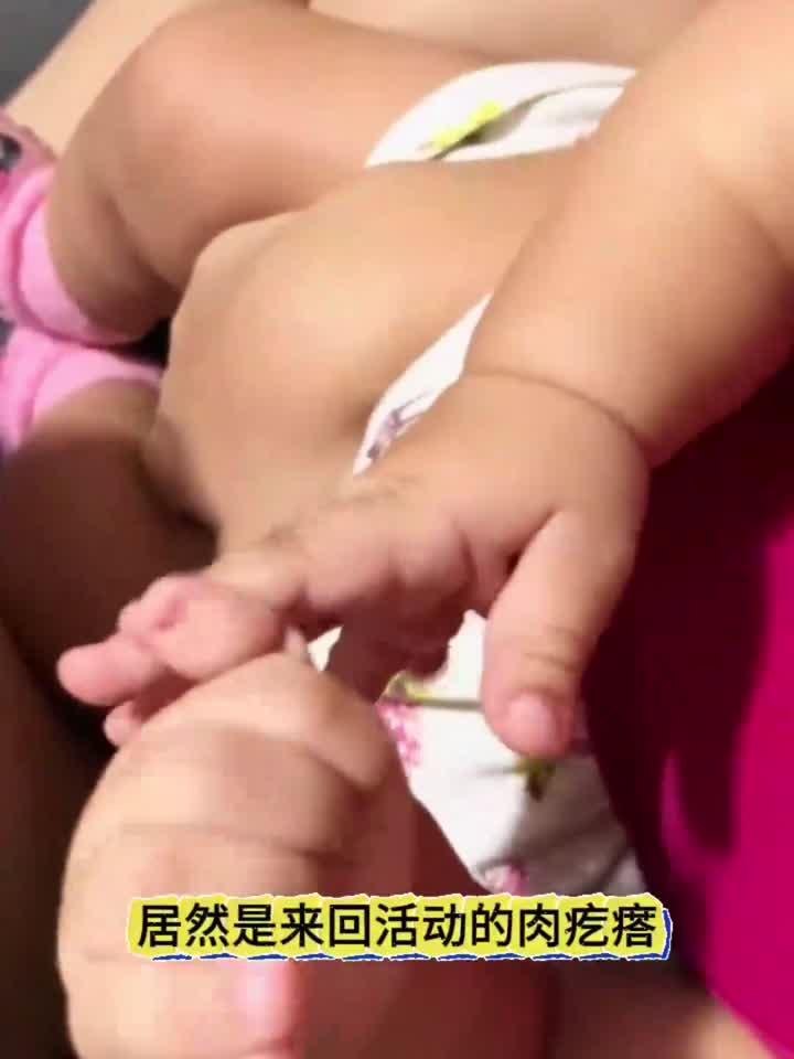 宝宝饿第六根手指,会不会影响呀