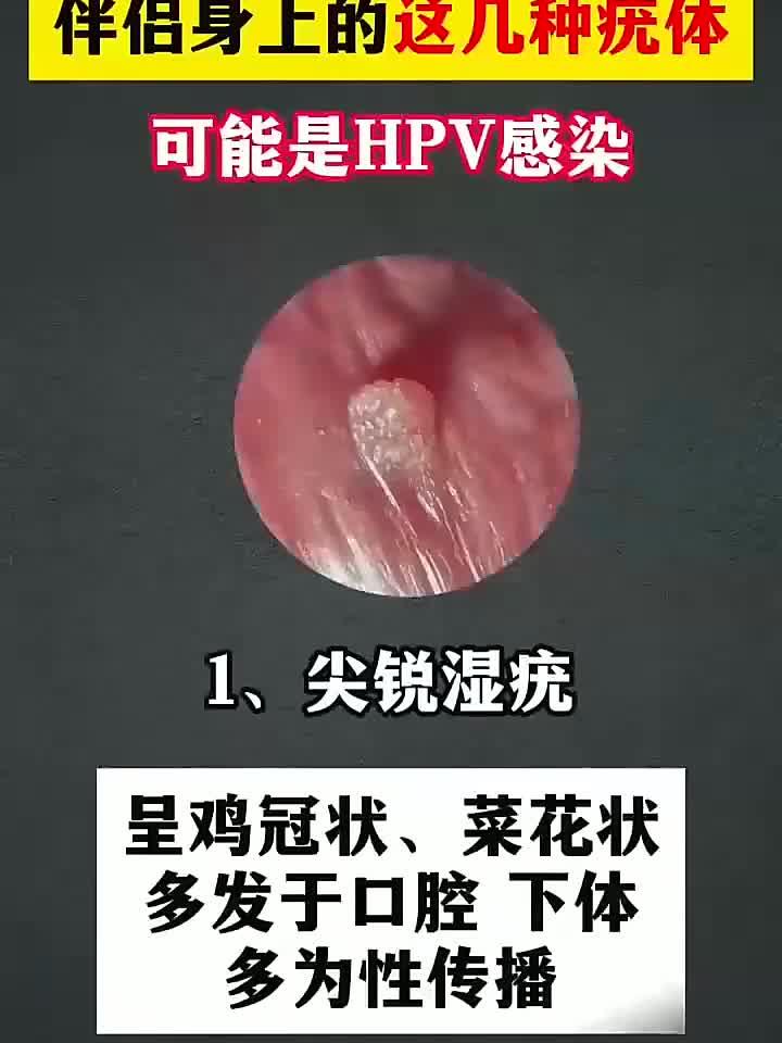 伴侣私处长疣别忽视,可能是HPV感染信号!