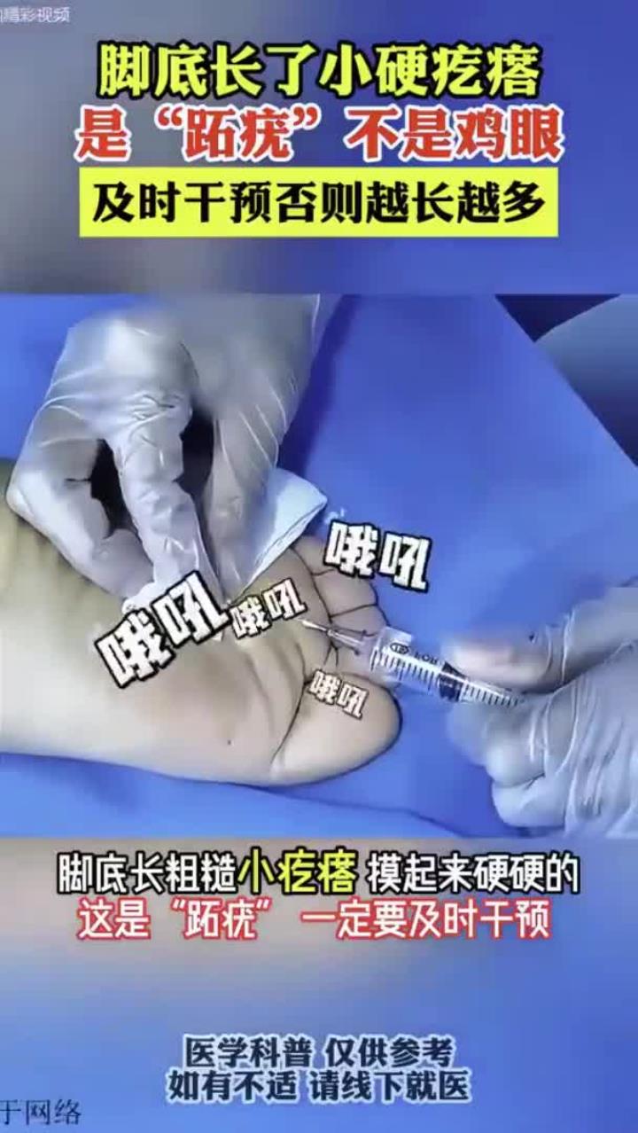 是跖疣不是鸡眼，及时干预否则越长越多！