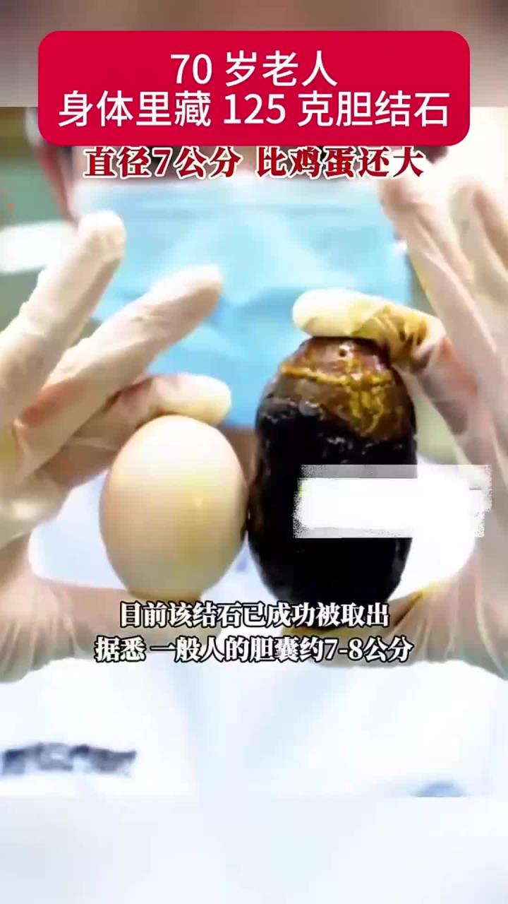 健康养生:健康养生:老人体内藏125克胆结石,直径7公分,比鸡蛋还大