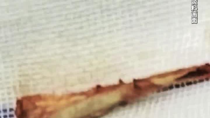 六旬老人吞鸡骨险丧命鸡骨头 卡喉咙怎么办