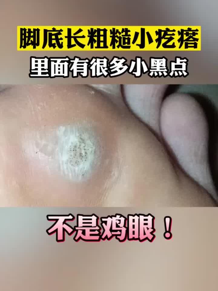 脚底板长小疙瘩,里面有很多小黑点,可别当鸡眼治!这是跖疣