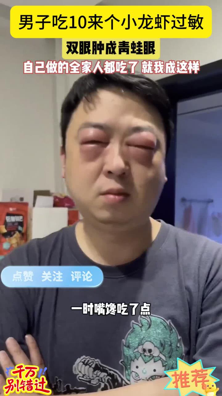 近日，江苏一男子吃过小龙虾后，双眼红肿过敏肿成青蛙眼一样