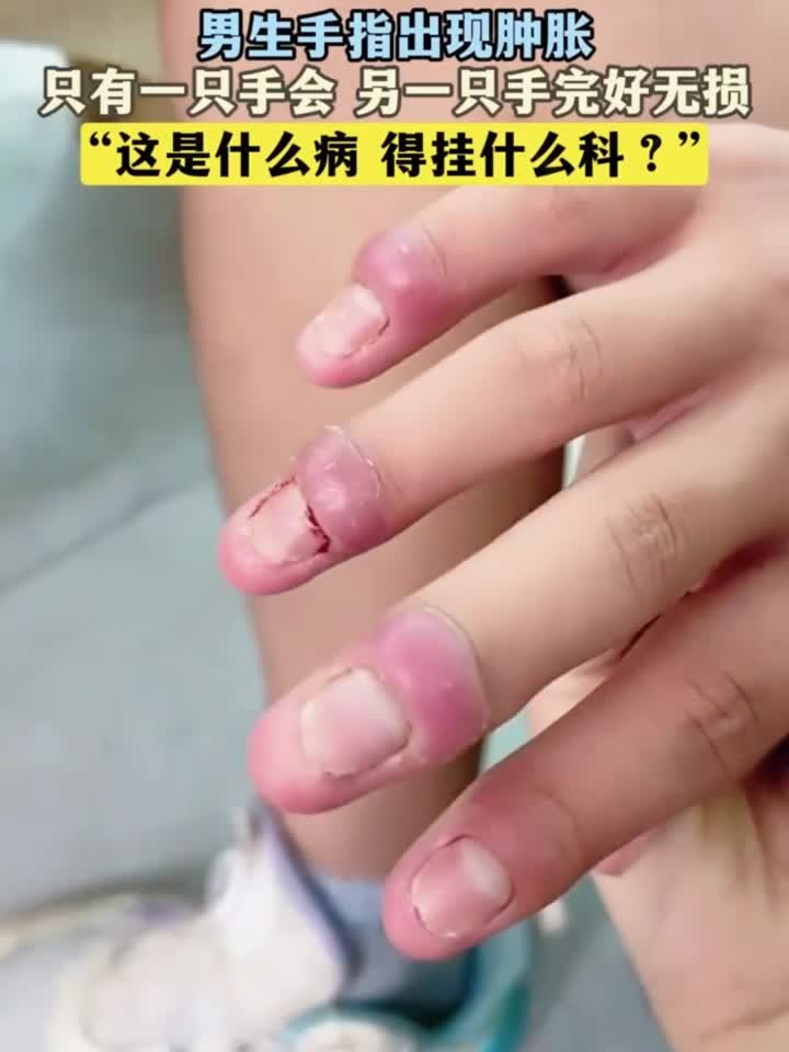 趣味健康:男生手指出现肿胀,只有一只手会 另一只手完好无损
