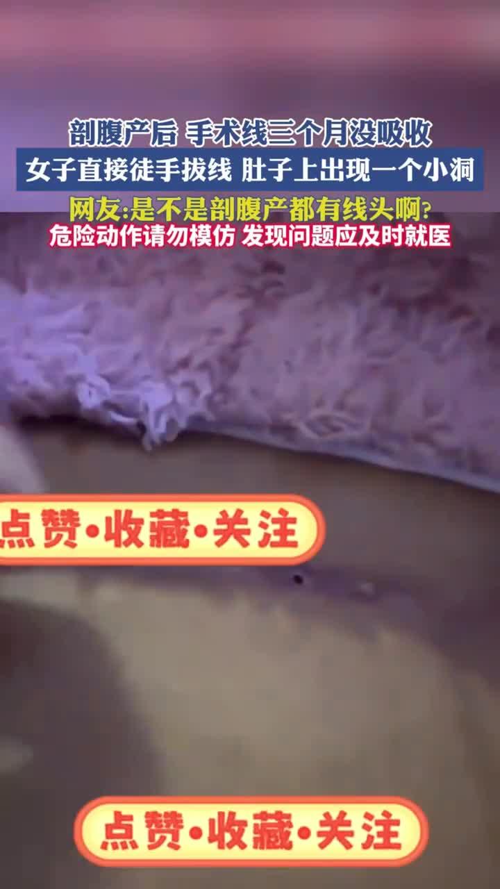 剖腹产后手术线三个月没吸收,女子直接徒手拔线