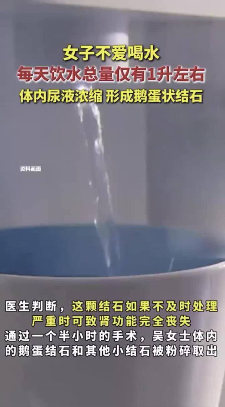 女子不爱喝水,每天饮水总量仅有1升左右,体内尿液浓缩,形成鹅
