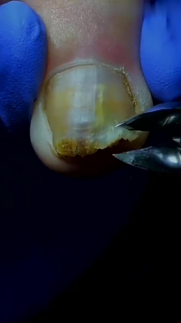 解压:脚趾甲内增生,修脚