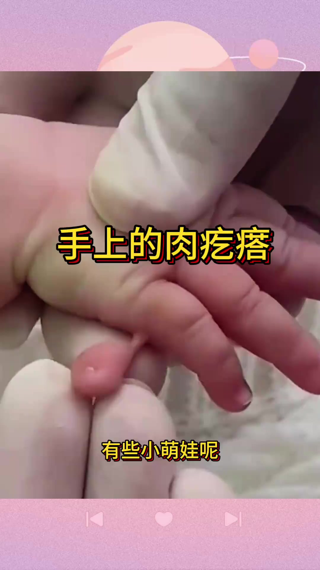 “小萌娃手指肉疙瘩:保留还是去除,引发家长关注!”