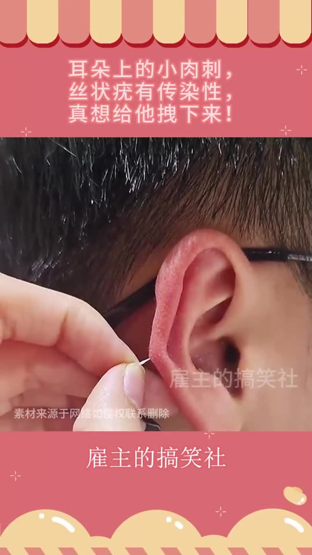 耳朵上的小肉刺,丝状疣有传染性,真想给他拽下来!