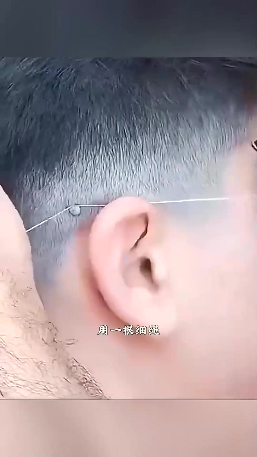  耳后长个小肉球,这样处理合理吗?
