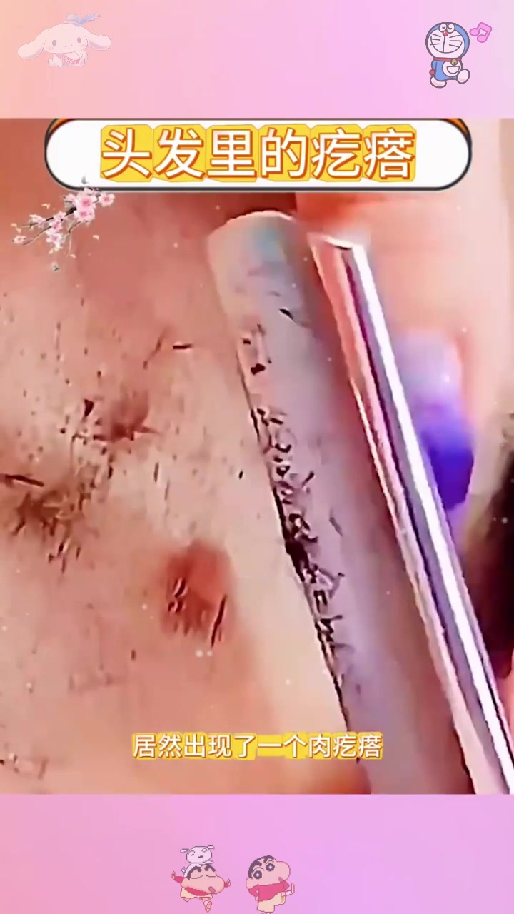  长在头上的肉疙瘩