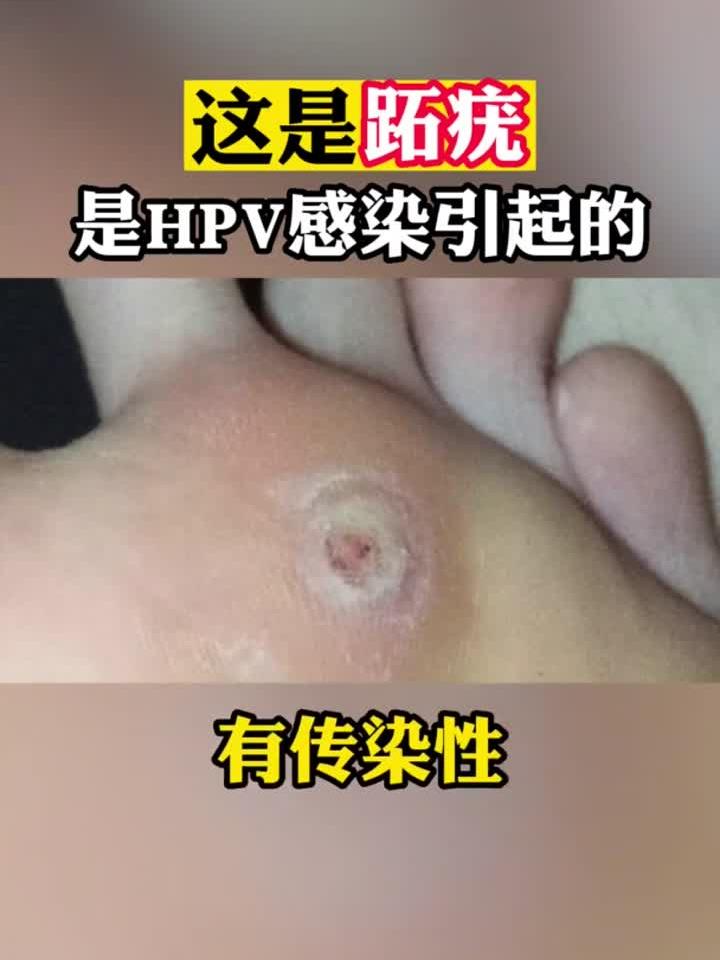 脚底板长小疙瘩,里面有很多小黑点,可别当鸡眼治!这是跖疣