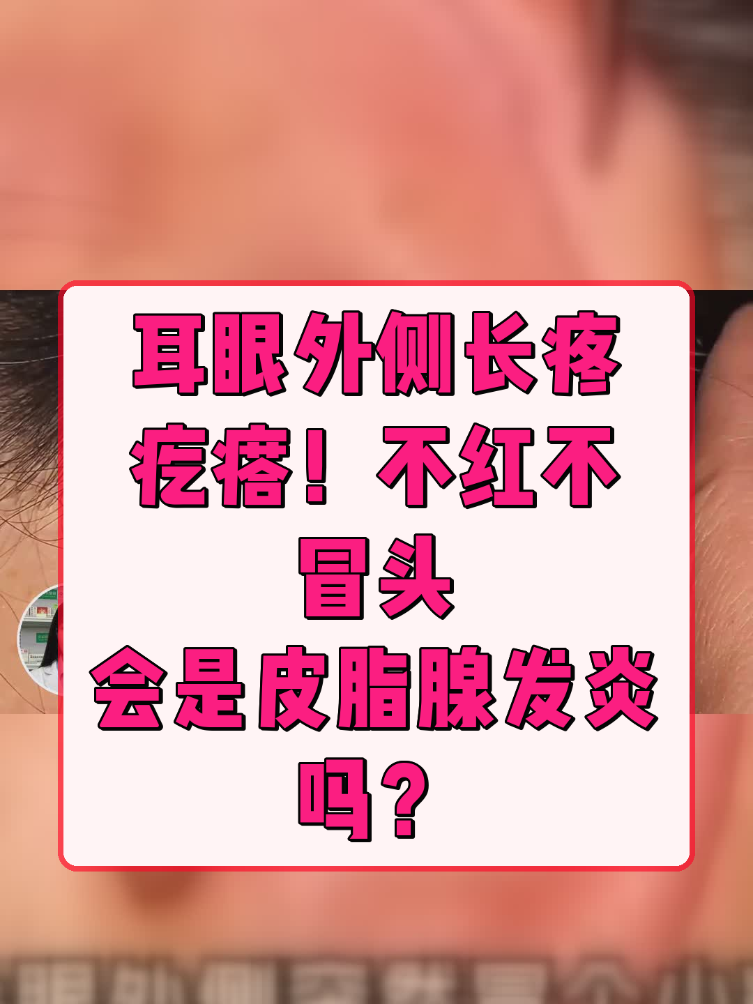 耳眼外侧长疼疙瘩！不红不冒头，会是皮脂腺发炎吗？