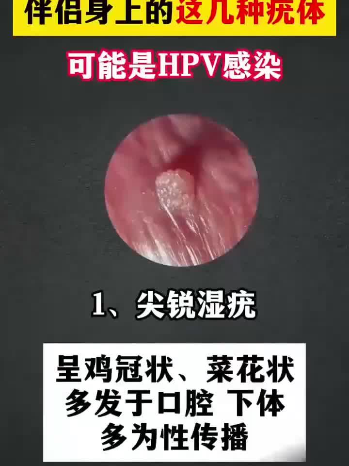 伴侣身上的疣体 可能是HPV感染