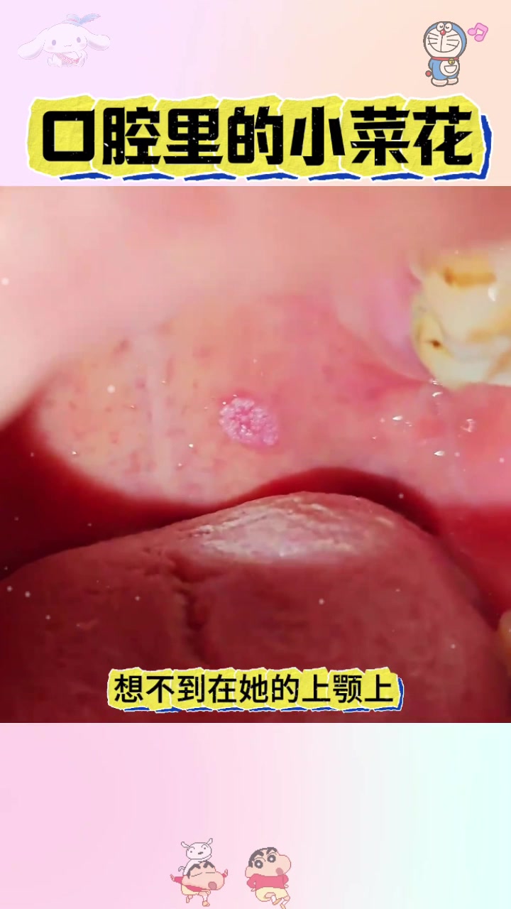  口腔里的小菜花,这是怎么了