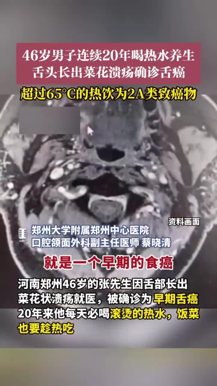 热水养生20年致舌癌,46岁男子确诊菜花样溃疡