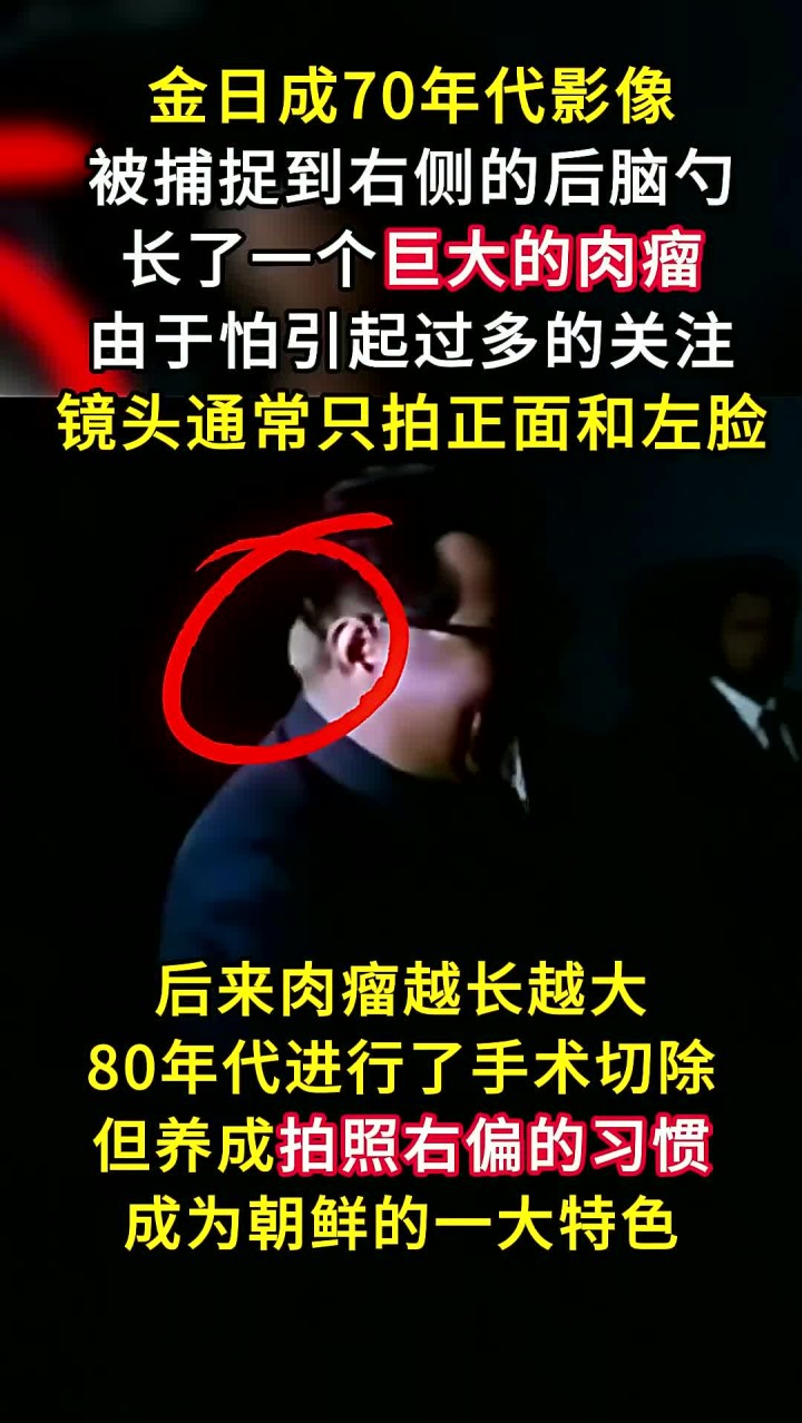 金日成70年代真实影像,右侧后脑显现巨大肉瘤,仅从左侧拍摄.mp4