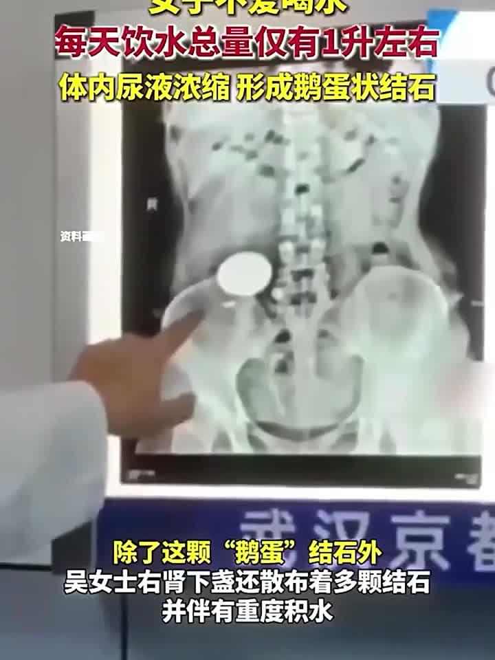 女子不爱喝水,每天饮水总量仅有1升左右,体内尿液浓缩,形成鹅