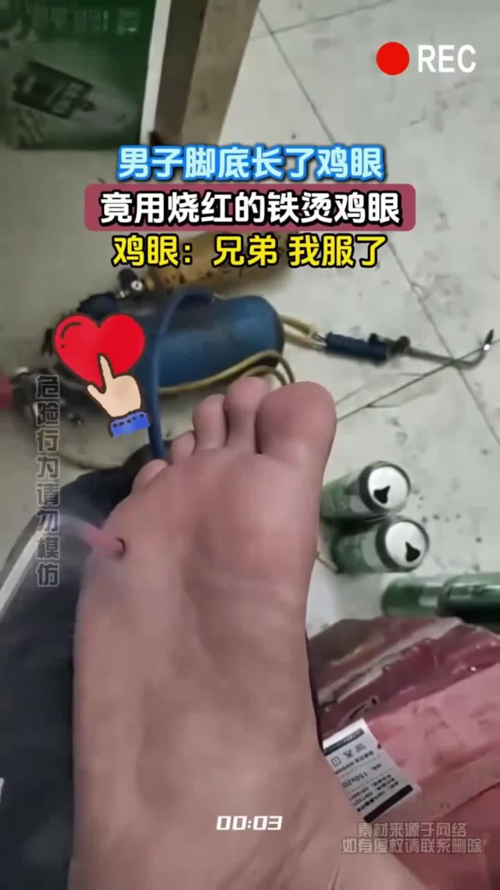男子脚底长了鸡眼,竟用烧红的铁烫鸡眼,鸡眼:兄弟 我服了