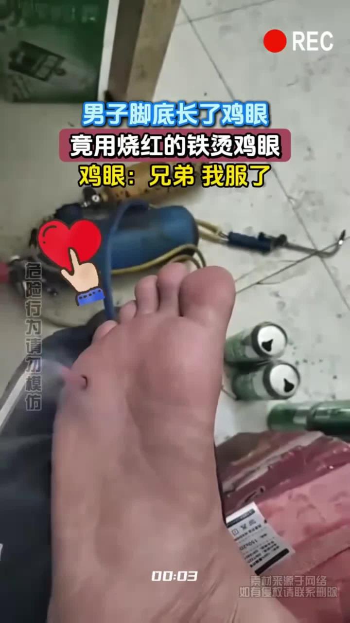 男子脚底长了鸡眼,竟用烧红的铁烫鸡眼,鸡眼:兄弟 我服了