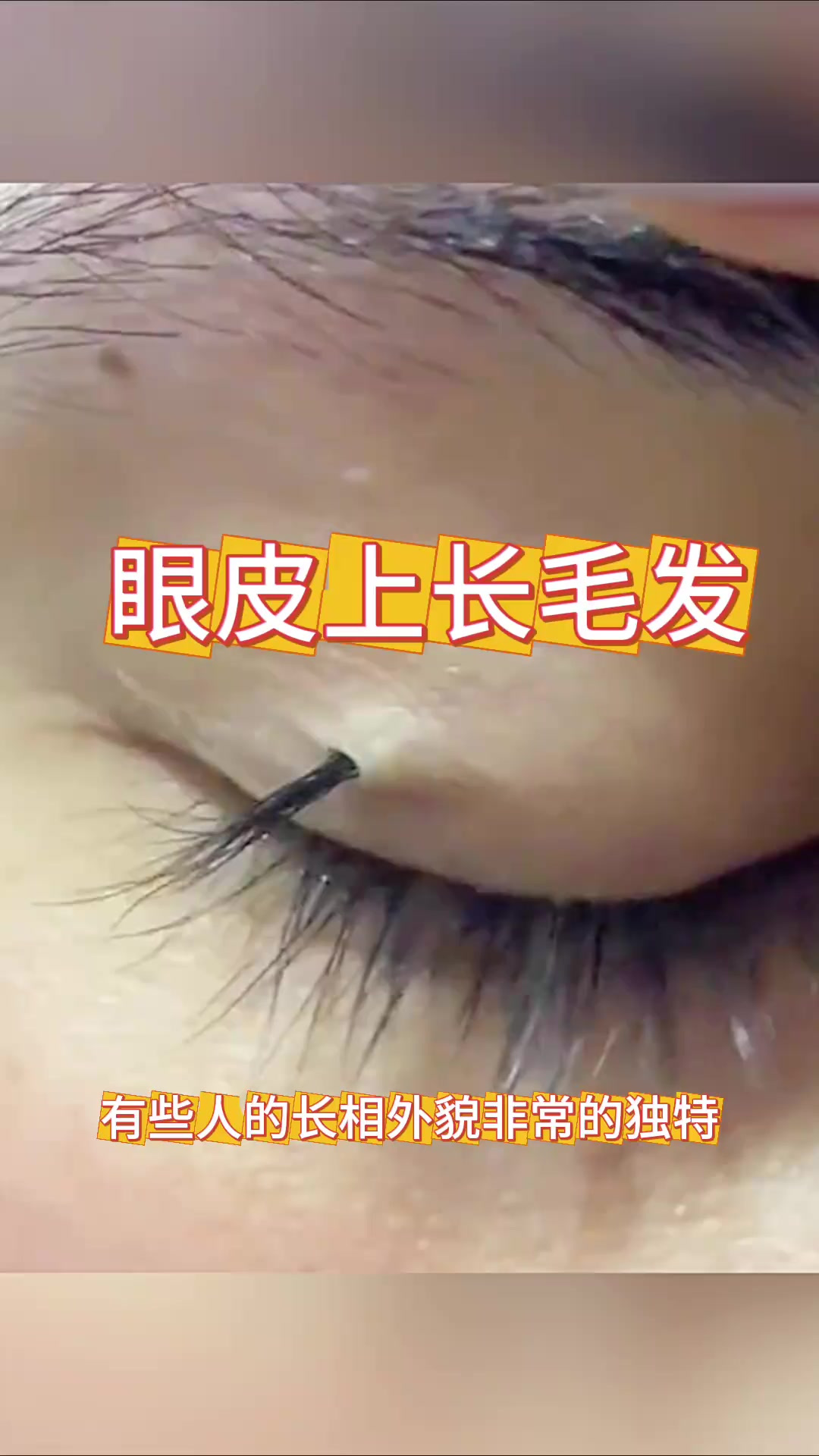女子眼皮生长黑色毛发,究竟是自然奇观还是隐藏的未解之谜?